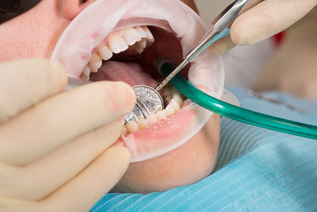 Read more about the article تركيبات الزيركون للأسنان في تركيا | تعرف على الأسعار والأنواع والمميزات