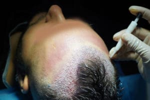 Read more about the article تكلفة زراعة الشعر في تركيا وهل تستحق المخاطرة؟