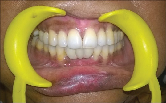 زراعة الأسنان الفورية