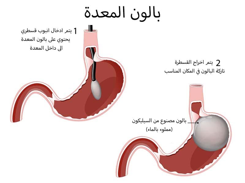 بالون-المعدة